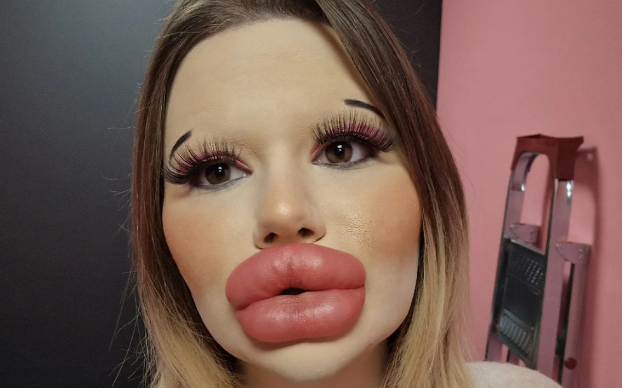 Deze Influencer 25 Heeft De Grootste Lippen Ter Wereld Nu Is Ze Toe Aan De Volgende 8383