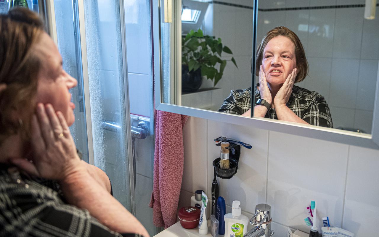 Karin Veldman is één van de 17 mensen met een zeer zeldzame huidziekte in nederland. De huidziekte heet Netherton.
