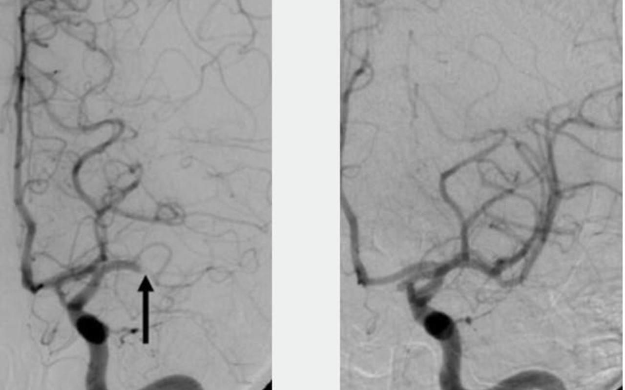 Twee afbeeldingen van bloedvaten in de hersenen: een stolsel bij pijl (links) en zichtbare hernieuwde doorstroming bloedvaten na verwijdering van het stolsel na katheterbehandeling (rechts), — © Maastricht UMC+ Twee afbeeldingen van bloedvaten in de hersenen: een stolsel bij pijl (links) en zichtbare hernieuwde doorstroming bloedvaten na verwijdering van het stolsel na katheterbehandeling (rechts), — © Maastricht UMC+